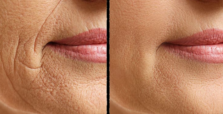 Smoker's Lines Treatment